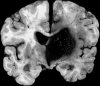 Hypertensive thalamic hemorrhage